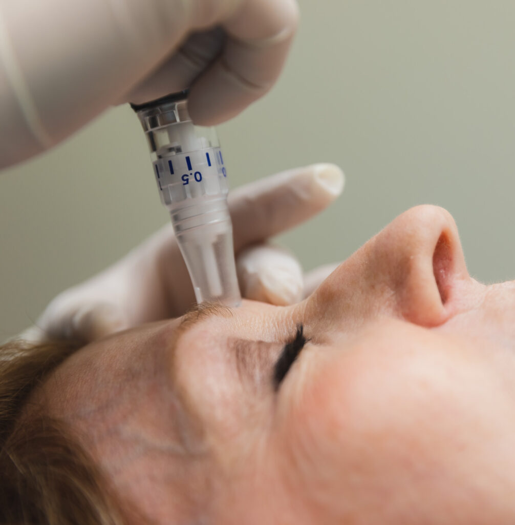 Close up of a woman getting a Microneedling and Radiofrequency treatment