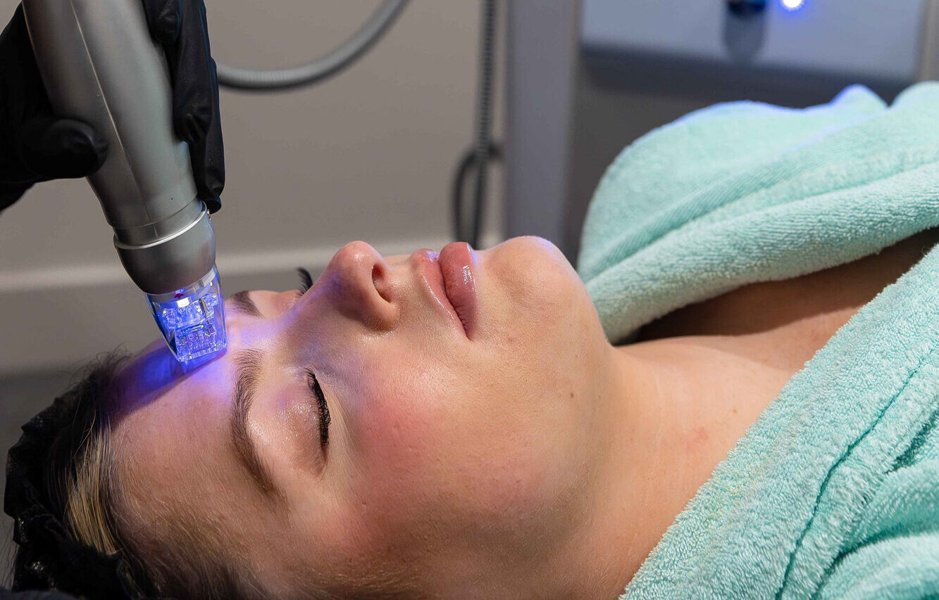 A patient lies down as a Smart Skin provider glides the Scarlet device across her face for RF for skin tightening in Homewood.
