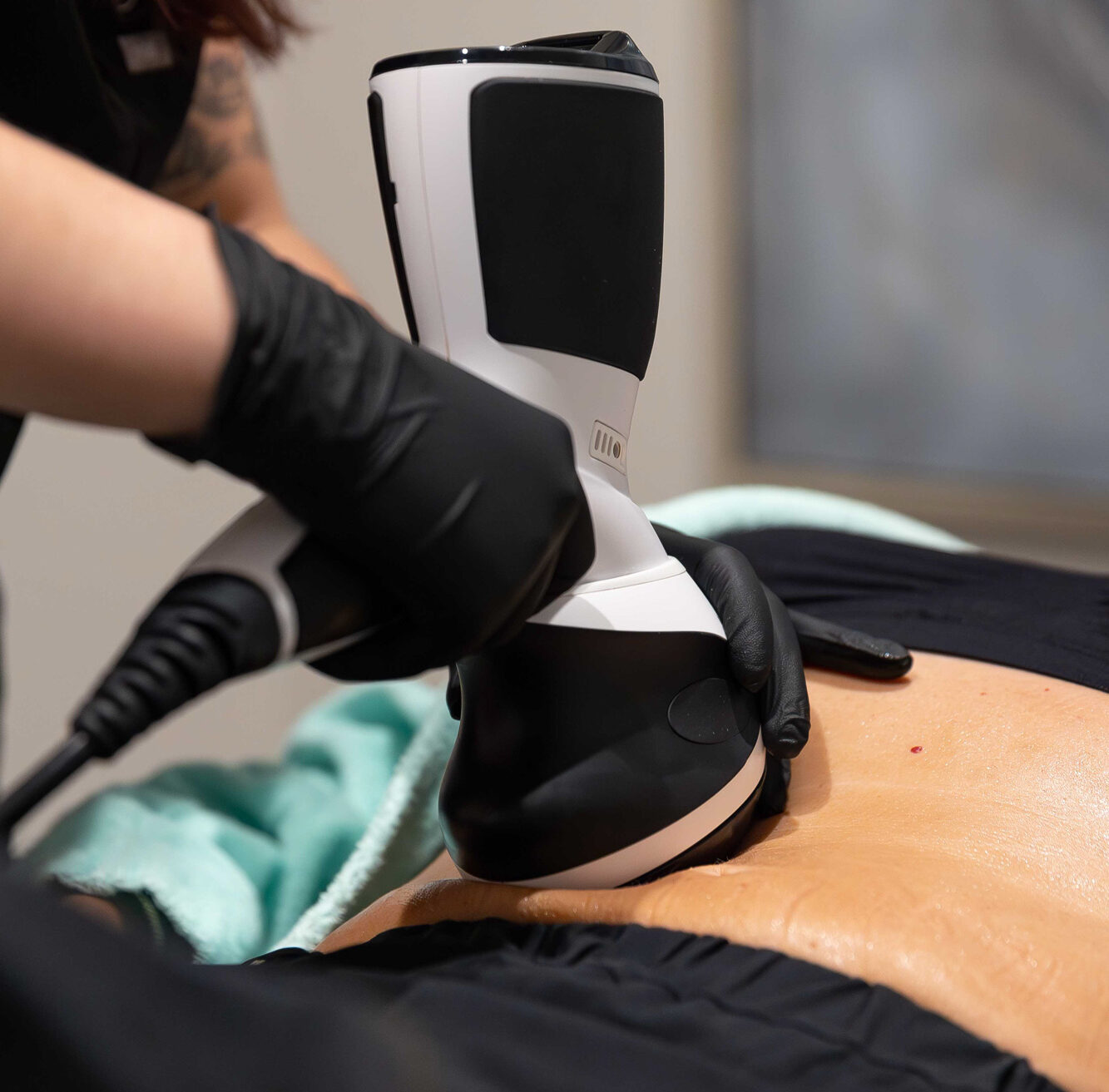 A Smart Skin Med Spa provider wearing black gloves, slowly moves the Viora applicator over the skin of a female patient's stomach. This customizable device can be used for skin tightening or laser hair removal near Hoover.